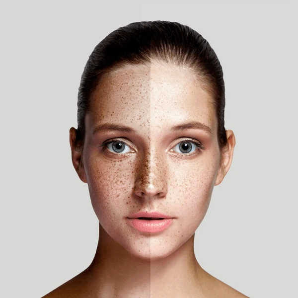 Dark Mark Reduction Treatment in Wagholi Pune